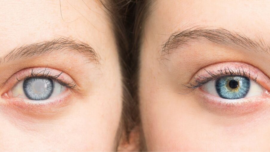 El diagnóstico precoz en la enfermedad de Coats, clave para evitar daños irreparables en la visión​