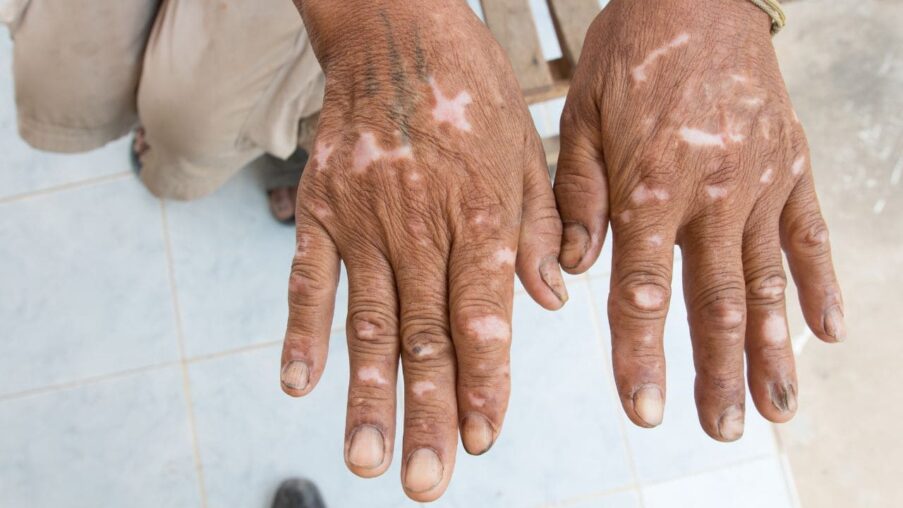 Reclaman al Gobierno la jubilación anticipada para personas con esclerodermia y con espina bífida​